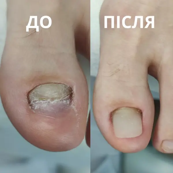 protez3-do-pislya