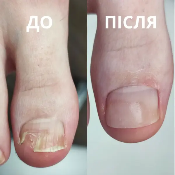 protez4-do-pislya